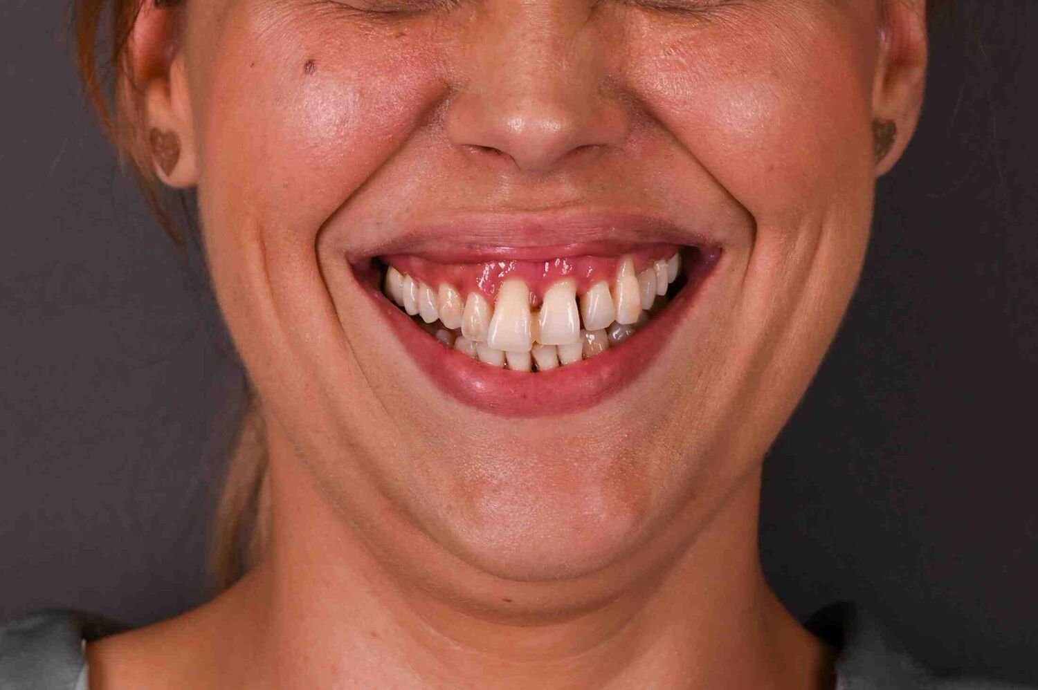 Pacient Clinica Dr. Alin Odor - Rezultat Implantologie